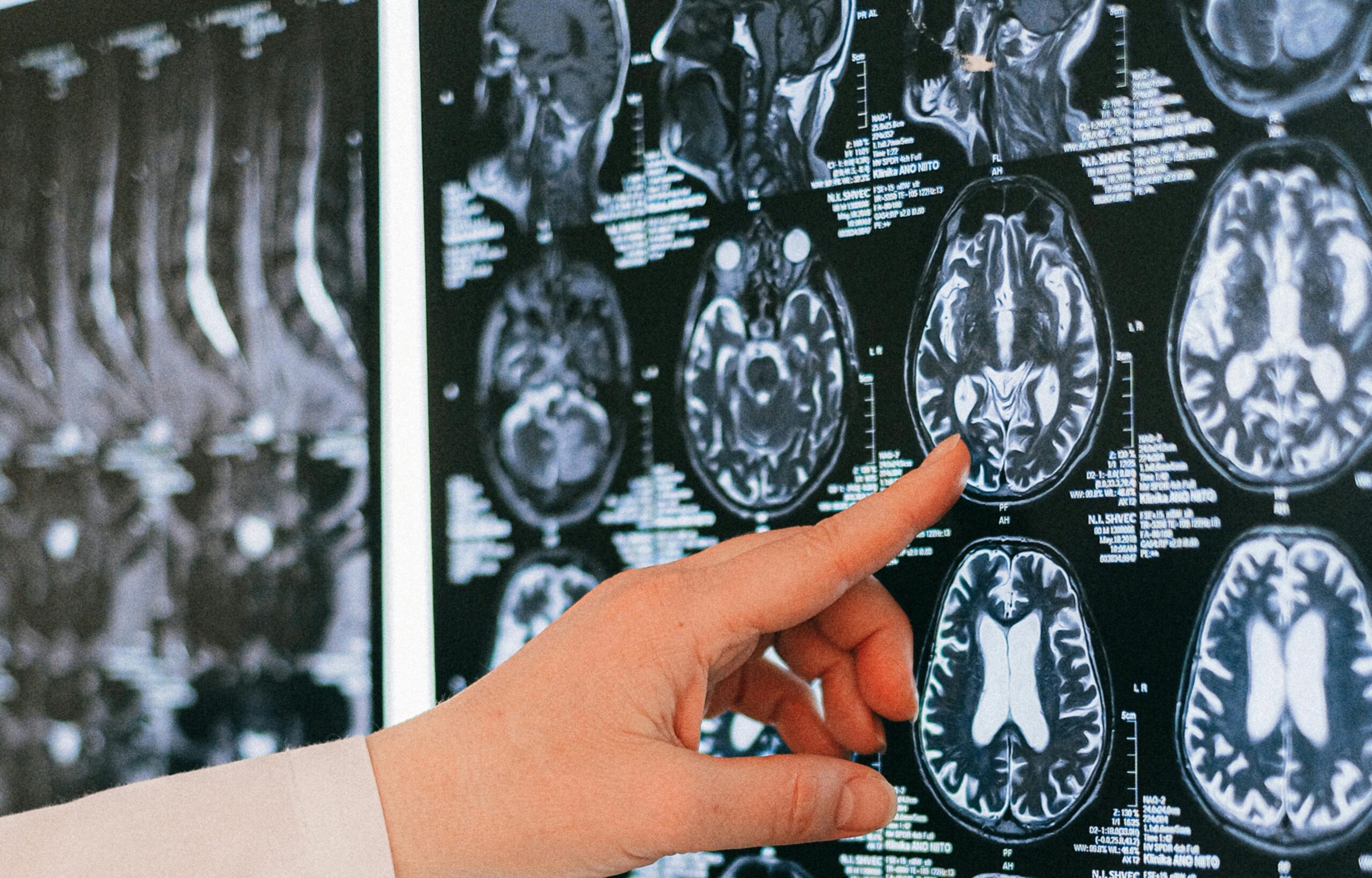 Leia mais sobre o artigo AVC – fatores de risco 